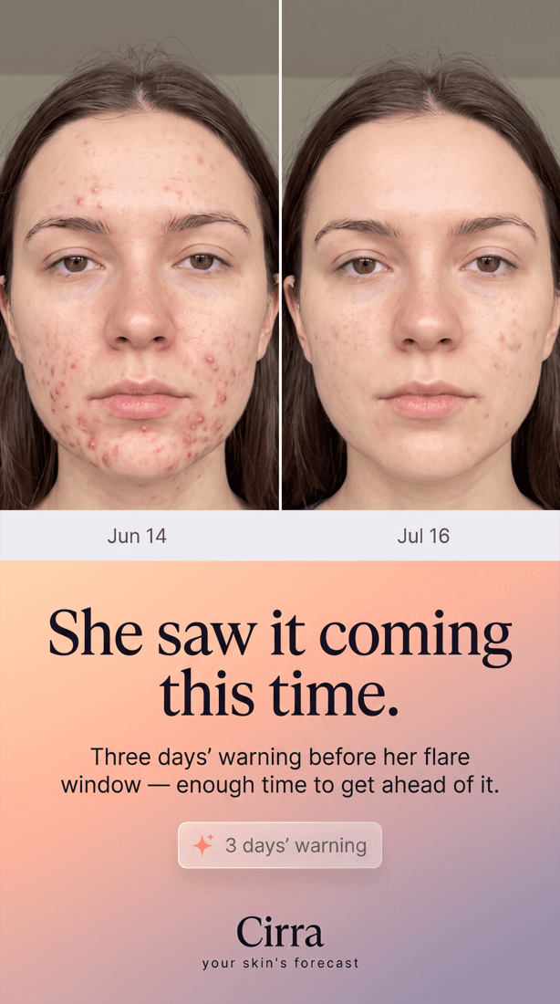 Two portraits of the same woman a month apart, the later one with fewer active breakouts.